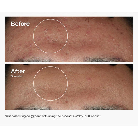 The Ordinary Niacinamide 10% + Zinc 1%