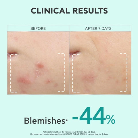 Apivita Just Bee Clear Anti-Blemishes Serum -NEW