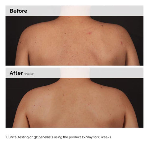 The Ordinary Body Care Salicylic Acid 0.5% Body Serum