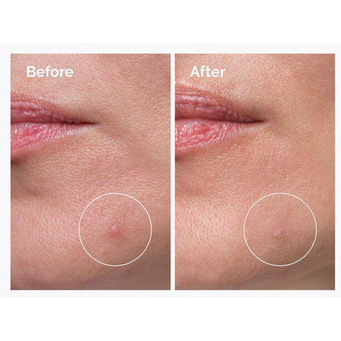 The Ordinary Sulfur 10% Powder-to-Cream Concentrate Θεραπεία κατά των ατελειών