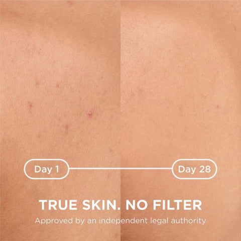 Biodera Sebium Kerato+ Body- NEW